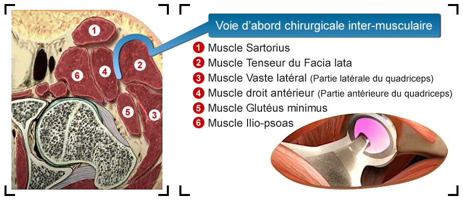voie-d-abord-chirurgicale-inter-musculaire-prothese-de-la-hanche