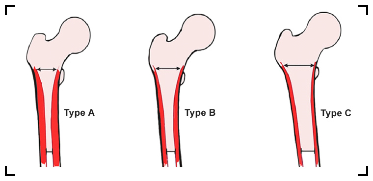 classification-de-dorr-de-la-forme-du-canal-du-femur