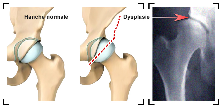 dysplasie-de-la-hanche-ou-arthrose-secondaire