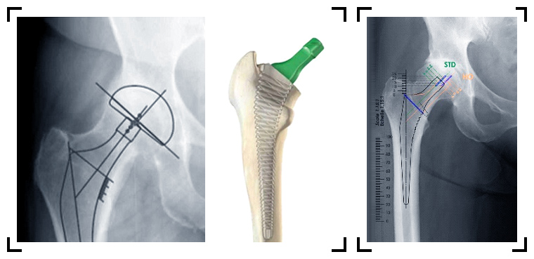 planification-d-implant-prothetique-de-la-hanche