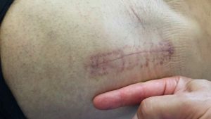 Cicatrice prothèse totale de hanche par voie antérieure mini-invasive