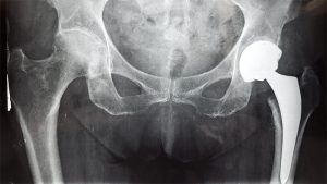 radiographie-prothese-totale-de-hanche-paris